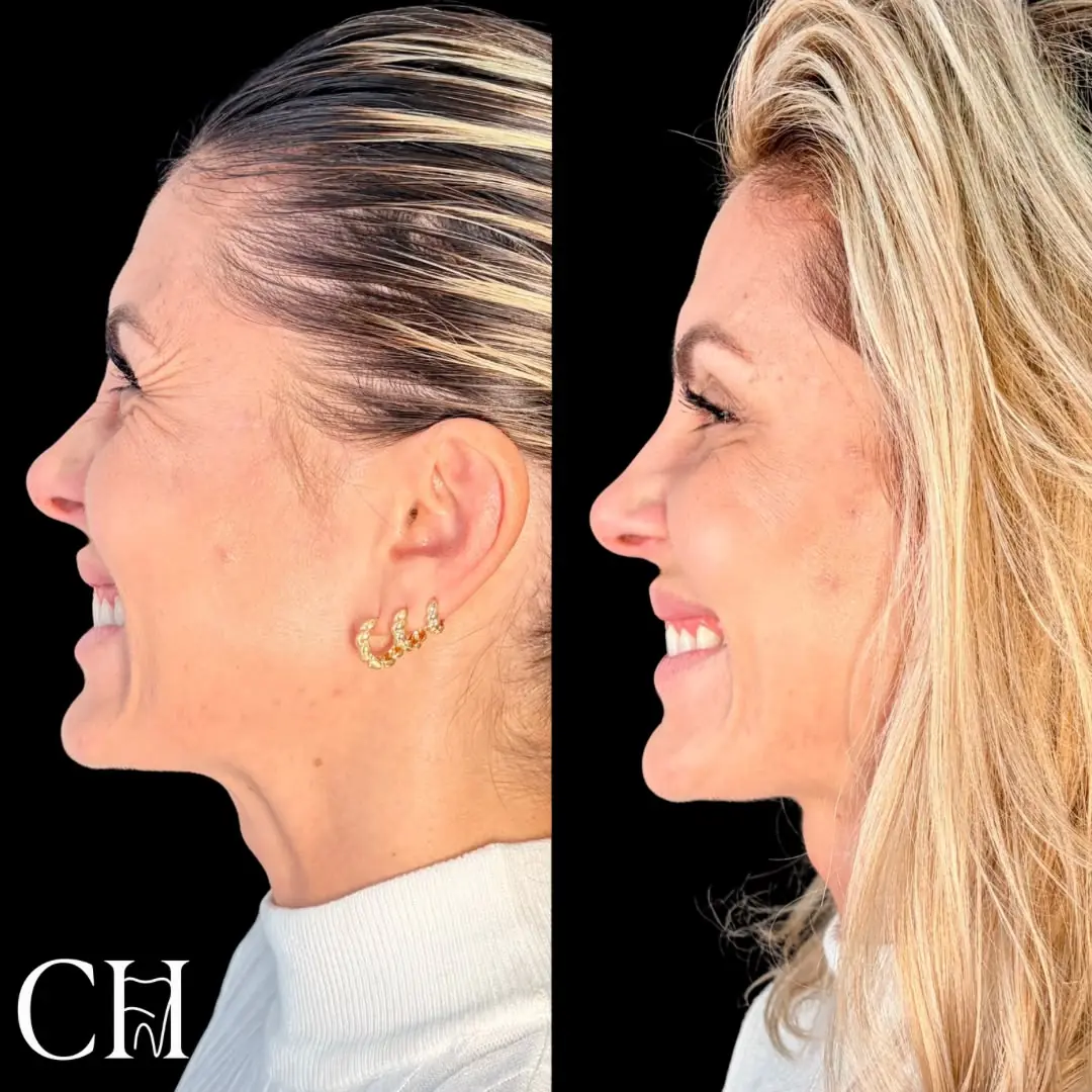Antes e depois de toxina botulínica em Curitiba
