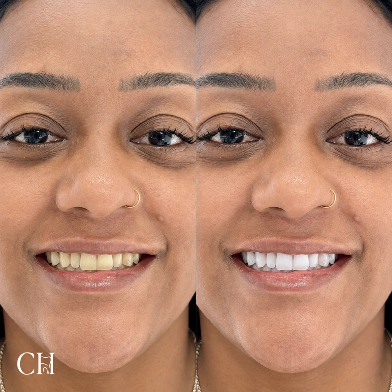 Clareamento dental — caso clínico 2 de 2