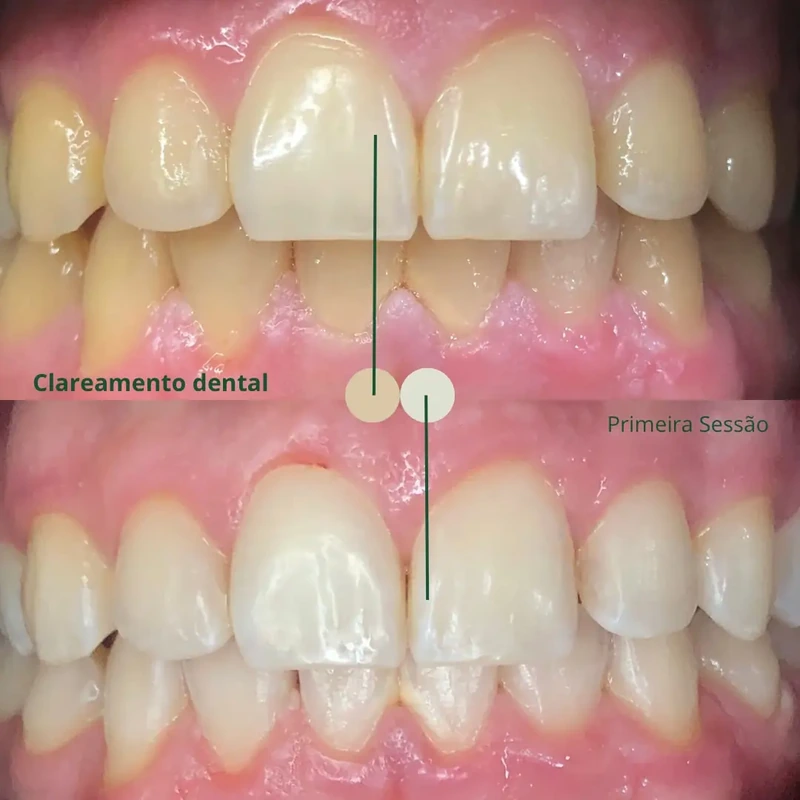 Clareamento dental — caso clínico 1 de 2