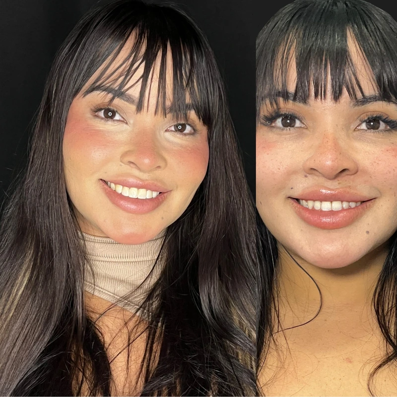 Facetas em resina — caso clínico 5 de 6