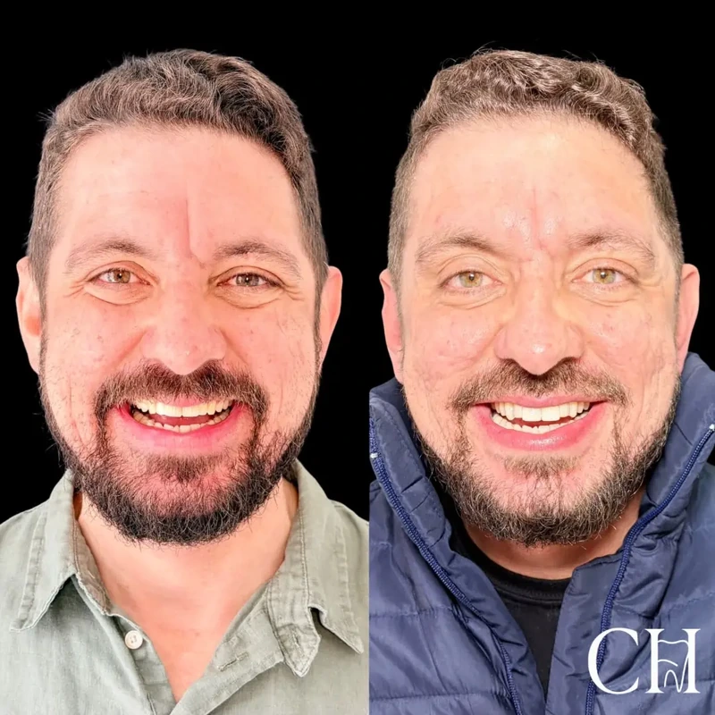 Facetas em resina — caso clínico 1 de 6