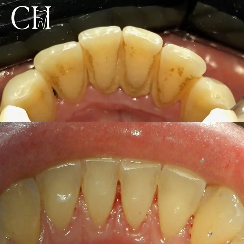 Limpeza dental — caso clínico 1 de 1
